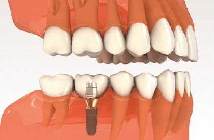 KỸ THUẬT TRỒNG RĂNG IMPLANT VÀ PHỤC HÌNH RĂNG SỨ TỨC THÌ